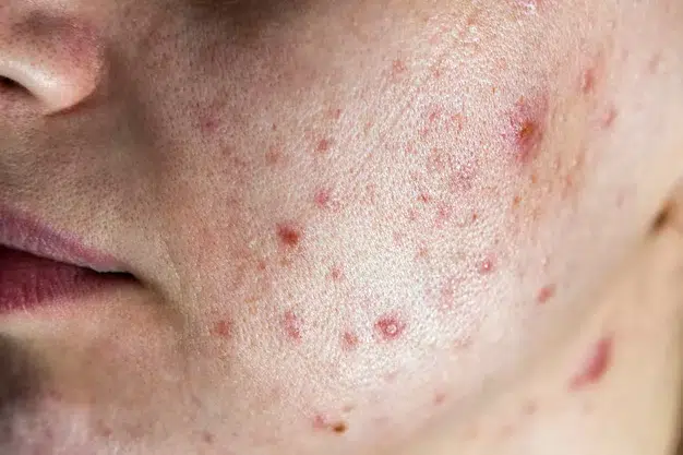 Acne