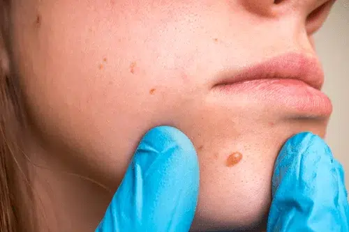 Benign Tumours