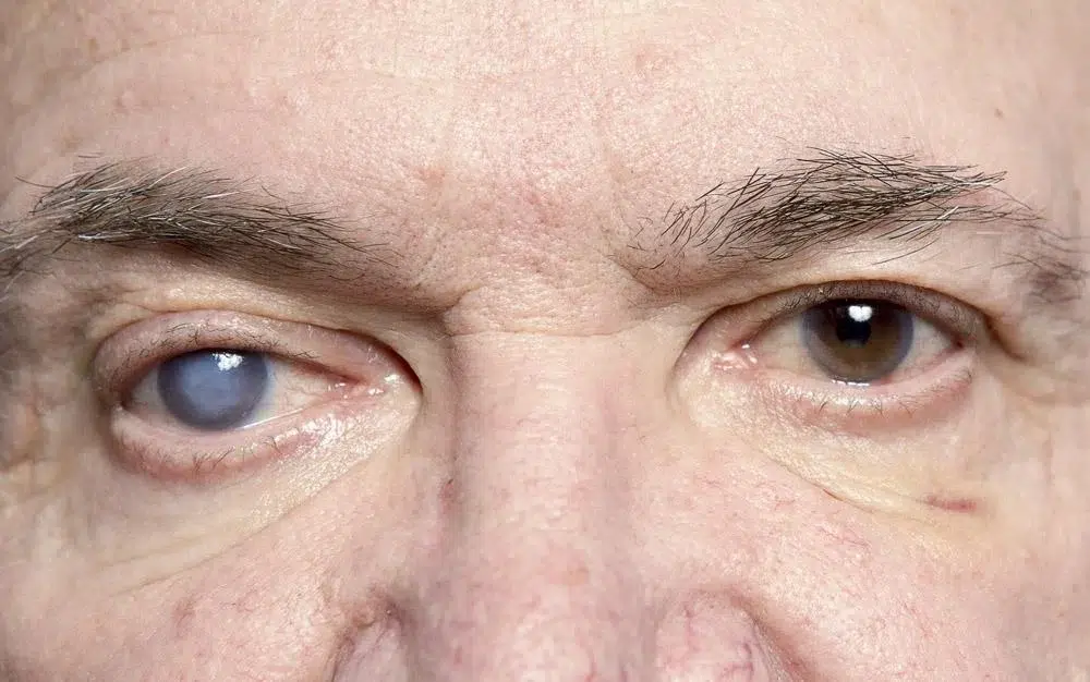 Cataracts