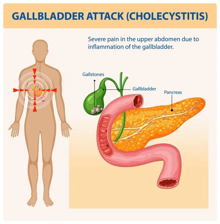 Cholecystitis