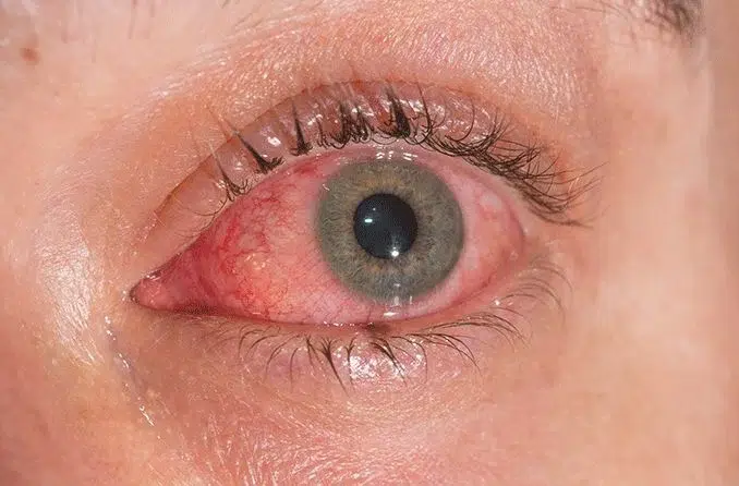 Is Your Eyes are Always Watery