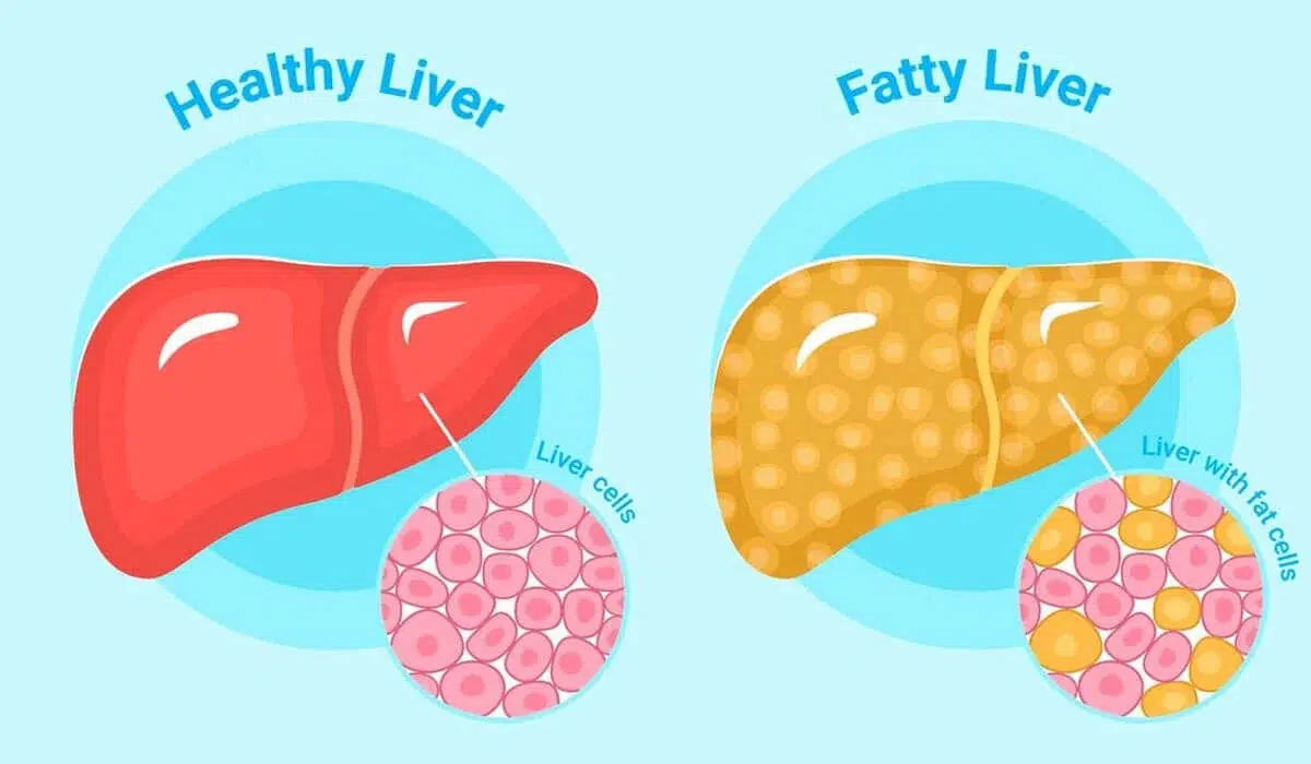 Understanding Fatty Liver