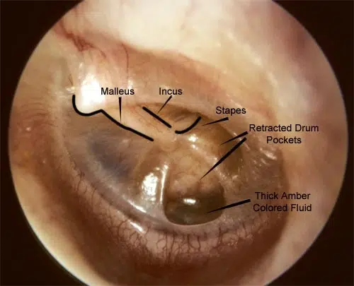 Glue Ear