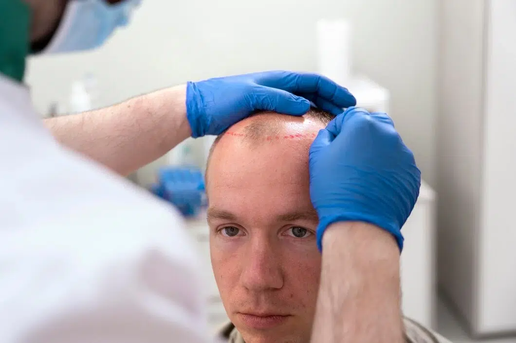 Hairline Transplant at Abbey Wood Hospital