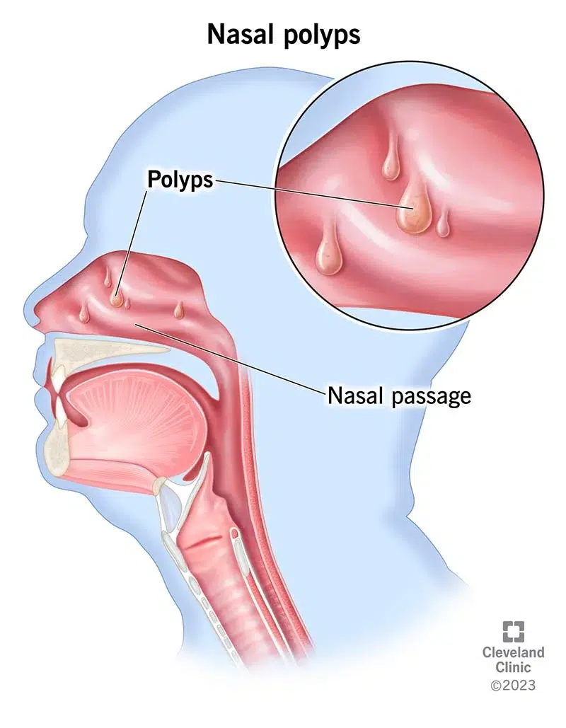 Understanding Polyps
