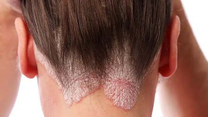 Understanding Psoriasis