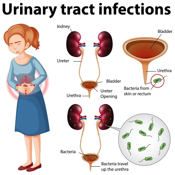 Urinary Track Infections