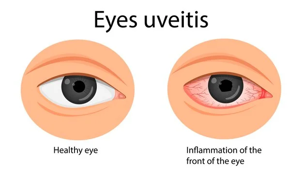 Uveitis: What It Is and How It's Treated