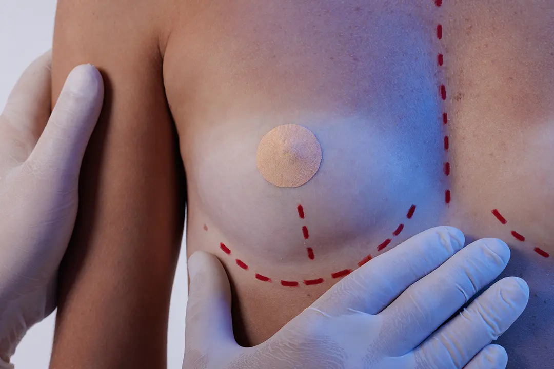 Breast uplift consultation at Abbey Wood Hospital North London