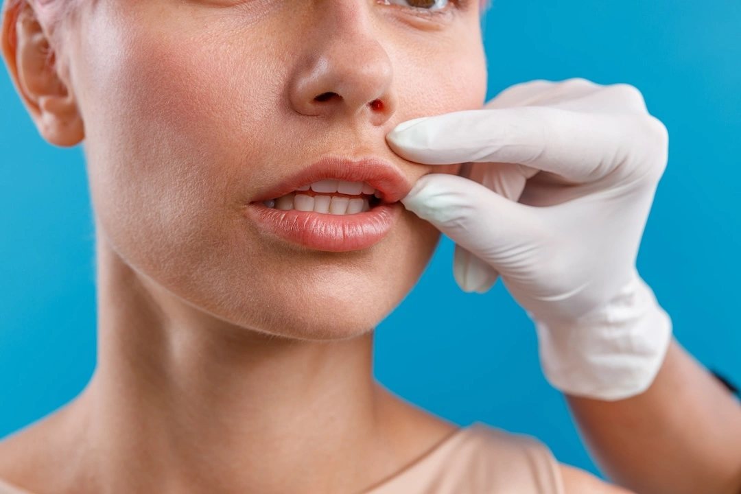 Lip Filler Safety- What to Know Before Your First Treatment