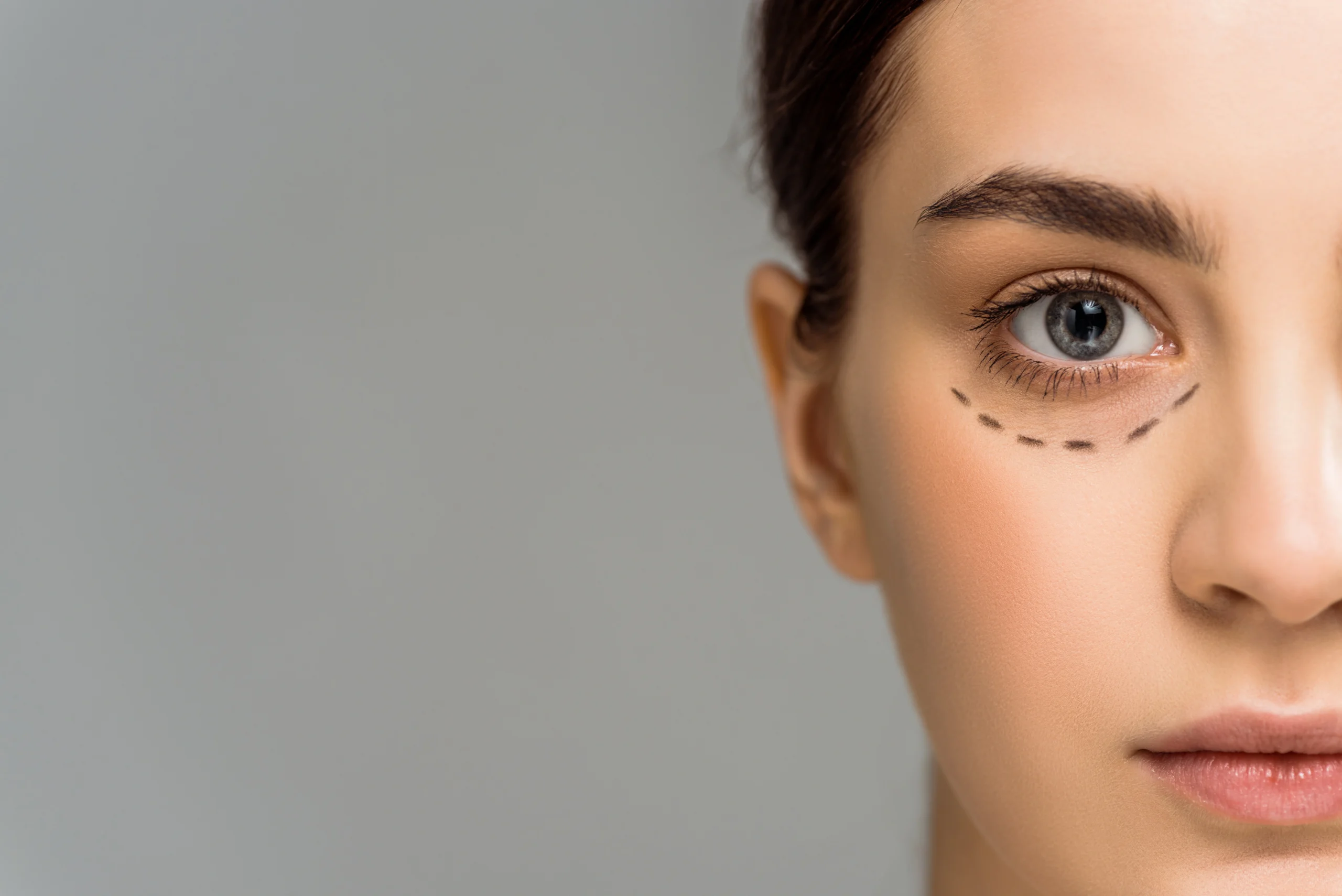 Consultant-led blepharoplasty eyelid surgery at Abbey Wood Hospital North London
